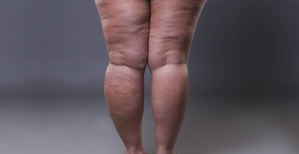 Lipoedema: Lemak Tak Normal Yang Sering Salah Diagnosis