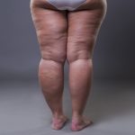 Lipoedema: Lemak Tak Normal Yang Sering Salah Diagnosis