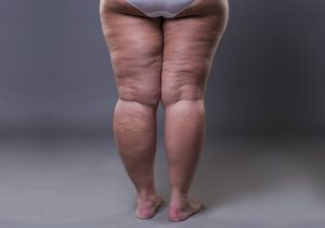Lipoedema: Lemak Tak Normal Yang Sering Salah Diagnosis