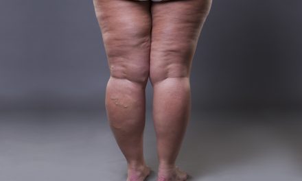 Lipoedema: Lemak Tak Normal Yang Sering Salah Diagnosis